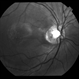 Optic Nerve Pit Optic Nerve Pit